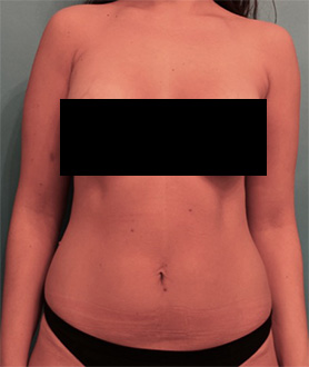 Liposuction before and after - after