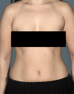 Liposuction before and after - before