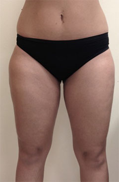 Liposuction before and after - after