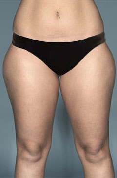Liposuction before and after - before