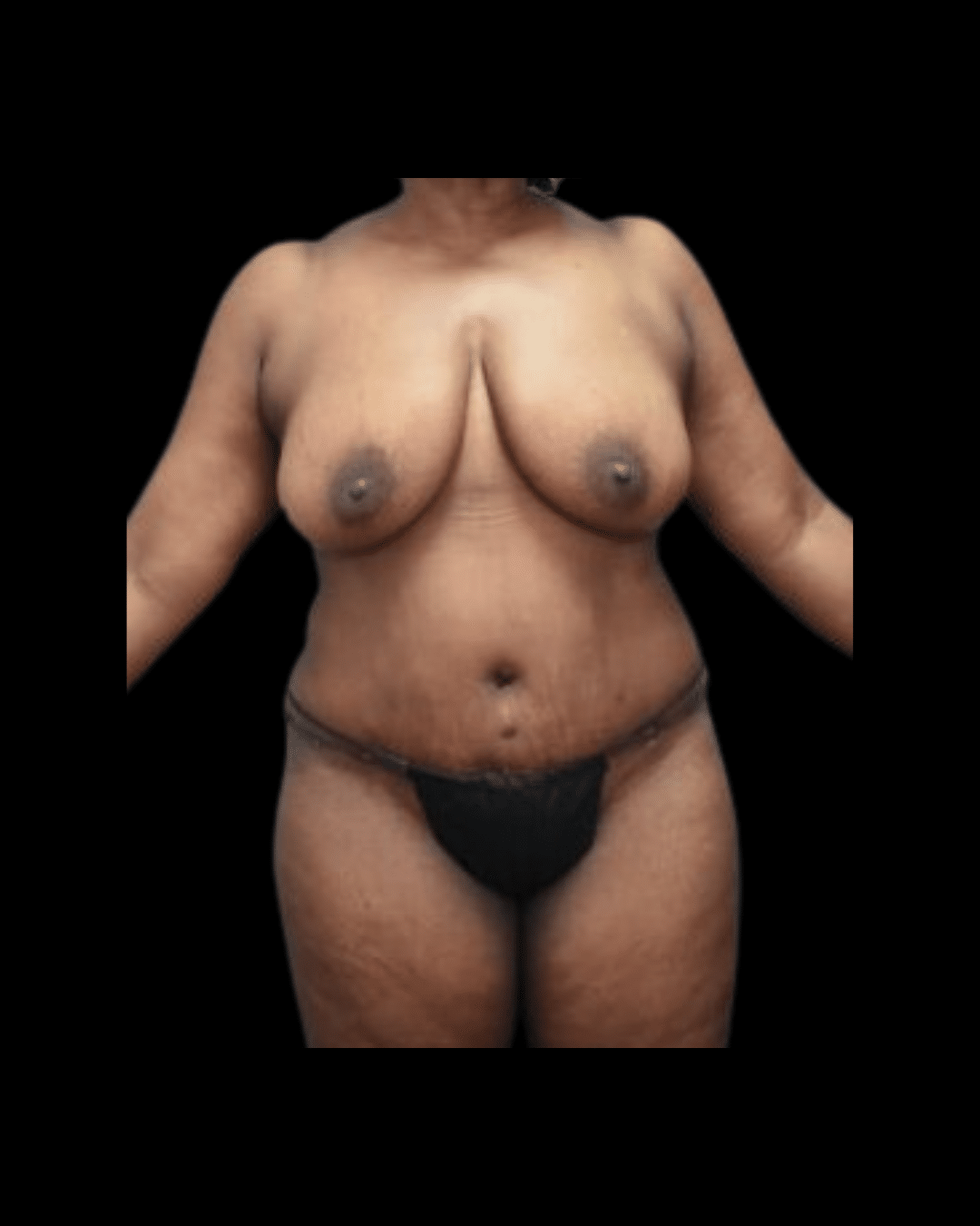 Abdominoplasty / Tummy Tuck before and after - after
