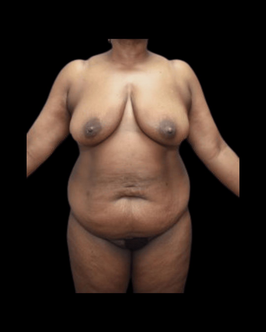 Abdominoplasty / Tummy Tuck before and after - before