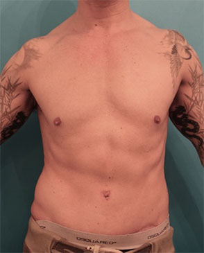 Abdominoplasty / Tummy Tuck before and after - after