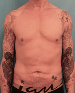 Abdominoplasty / Tummy Tuck before and after - before