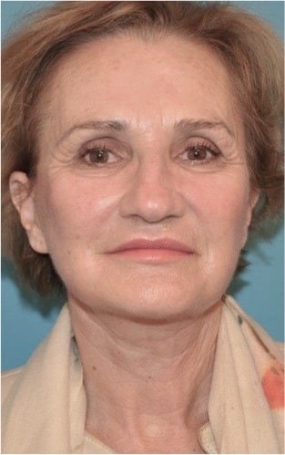Facelift before and after - after