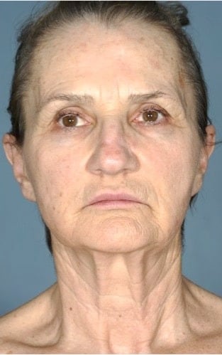 Facelift before and after - before