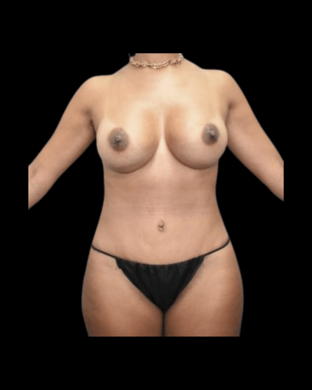 Abdominoplasty / Tummy Tuck before and after - after