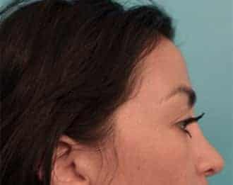 Rhinoplasty before and after - after