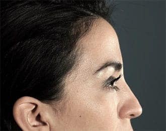 Rhinoplasty before and after - before