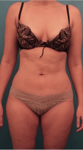 Liposuction before and after - after