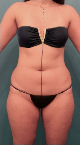 Liposuction before and after - before