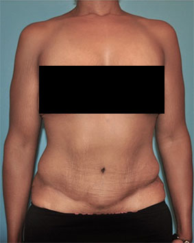 Abdominoplasty / Tummy Tuck before and after - after