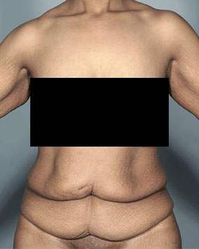 Abdominoplasty / Tummy Tuck before and after - before