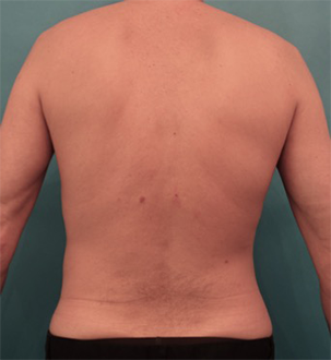 Liposuction before and after - after
