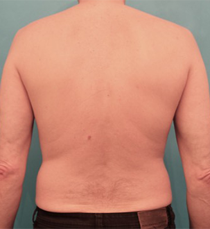 Liposuction before and after - before