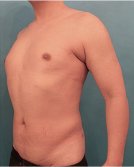 Liposuction before and after - after