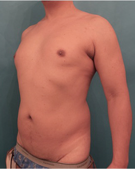 Liposuction before and after - before
