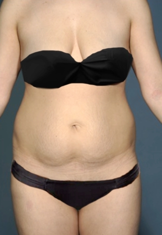 Abdominoplasty / Tummy Tuck before and after - before