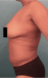 Liposuction before and after - after