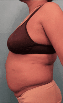 Liposuction before and after - before