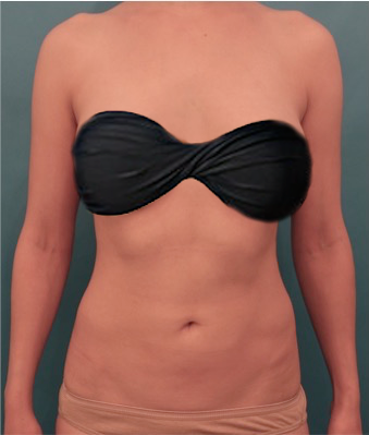 Liposuction before and after - after