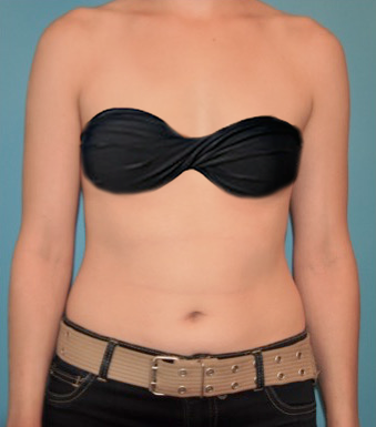 Liposuction before and after - before