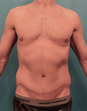 Abdominoplasty / Tummy Tuck before and after - after