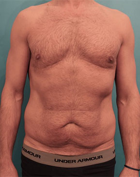 Abdominoplasty / Tummy Tuck before and after - before