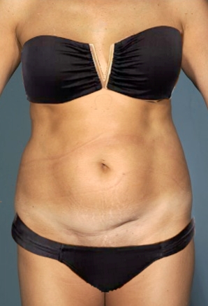 Abdominoplasty / Tummy Tuck before and after - before