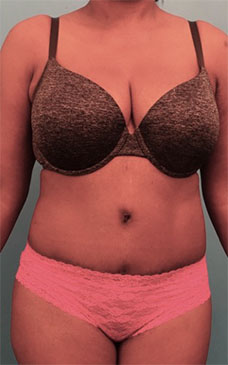 Abdominoplasty / Tummy Tuck before and after - after