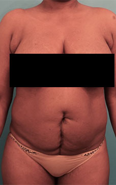 Abdominoplasty / Tummy Tuck before and after - before