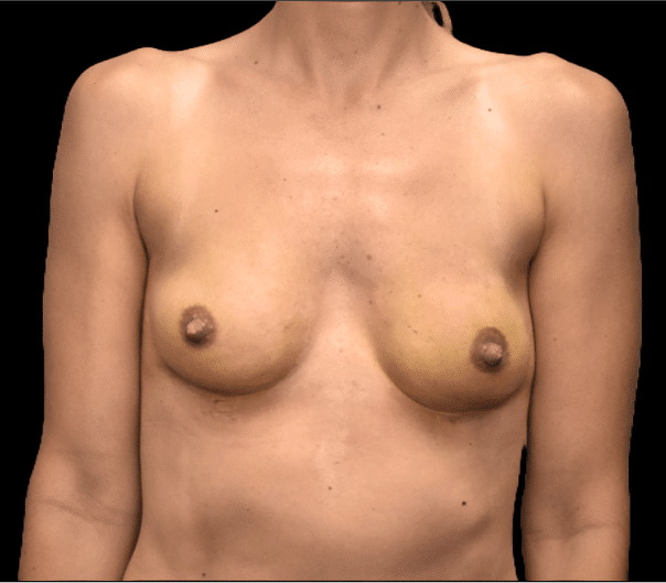 Breast Augmentation before and after - after