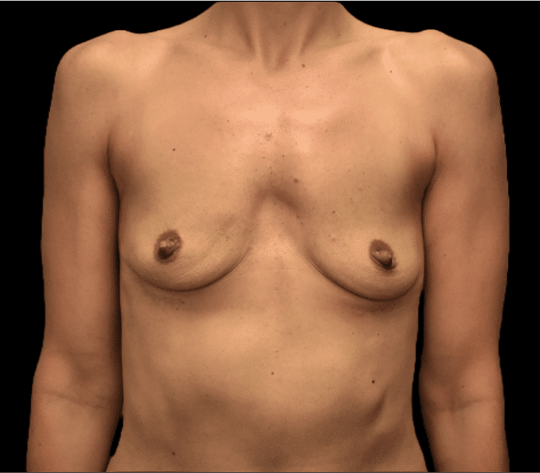 Breast Augmentation before and after - before