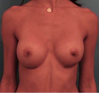 Breast Augmentation before and after - after