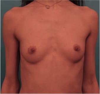Breast Augmentation before and after - before