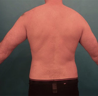 Liposuction before and after - after