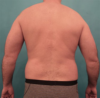 Liposuction before and after - before