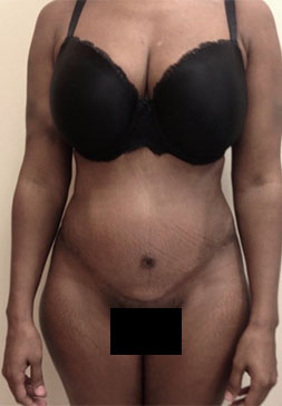 Abdominoplasty / Tummy Tuck before and after - after