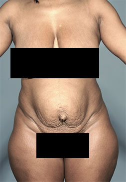 Abdominoplasty / Tummy Tuck before and after - before