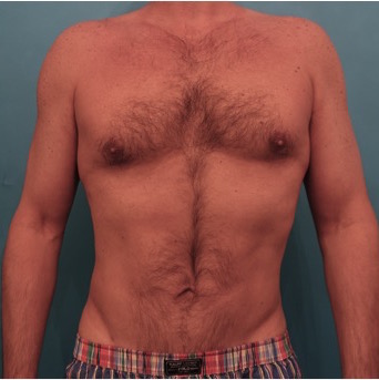 Liposuction before and after - after