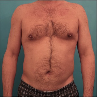 Liposuction before and after - before
