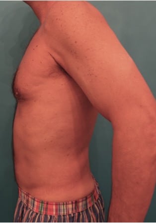 Liposuction before and after - after