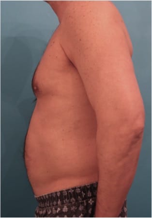 Liposuction before and after - before