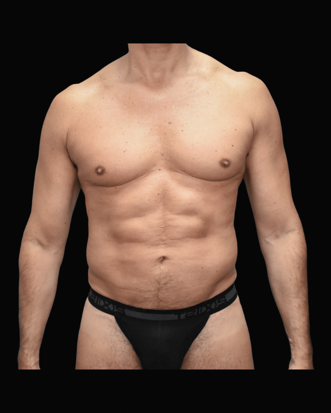 Liposuction before and after - after