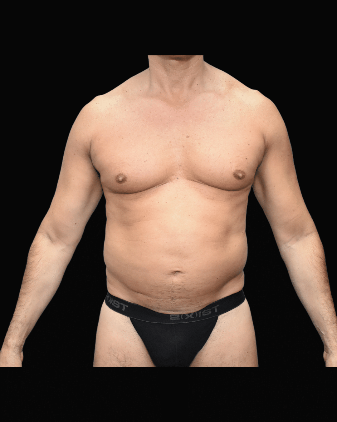 Liposuction before and after - before