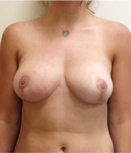Breast Lift before and after - after