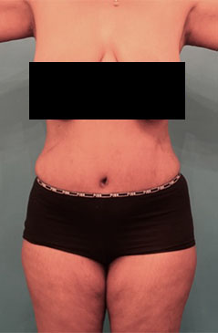 Abdominoplasty / Tummy Tuck before and after - after