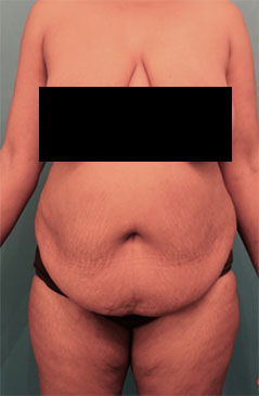 Abdominoplasty / Tummy Tuck before and after - before