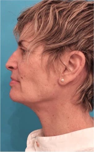 Neck Lift by Dr. Sachin Shridharani — after