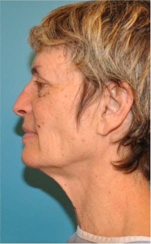 Neck Lift by Dr. Sachin Shridharani — before